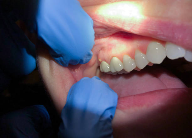Best Emergency Dental Care for Broken or Chipped Teeth in Lynden, WA
