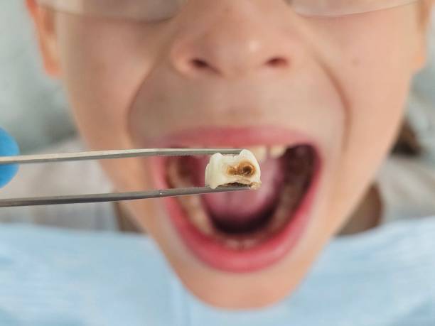 Best Emergency Dental Care for Broken or Chipped Teeth in Lynden, WA